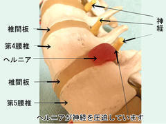 椎間板ヘルニア模型.jpg